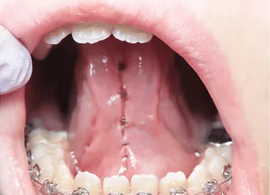 After tongue tie release — restored tongue mobility