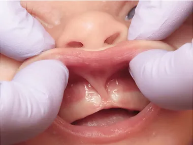Before lip tie release — restrictive frenulum visible between the upper lip and gums