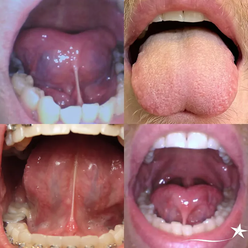 Tongue Ties in Adults: What They Look Like, How They Affect Your Health, and How to Fix Them