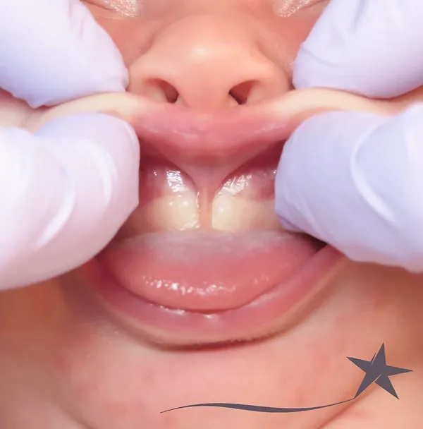 Clinical close-up of a lip tie — restrictive frenulum visible between the upper lip and gums